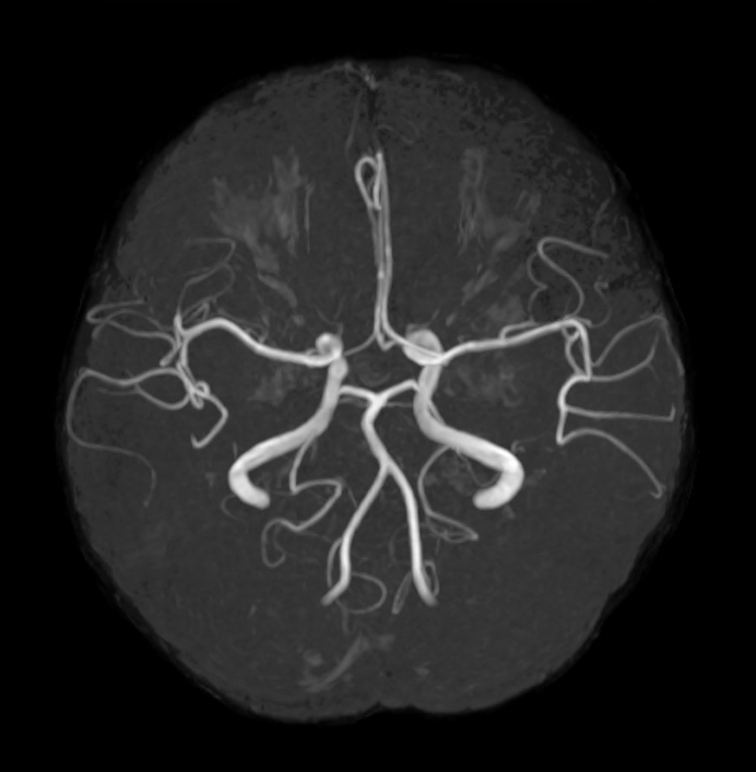 頭部MRA検査
