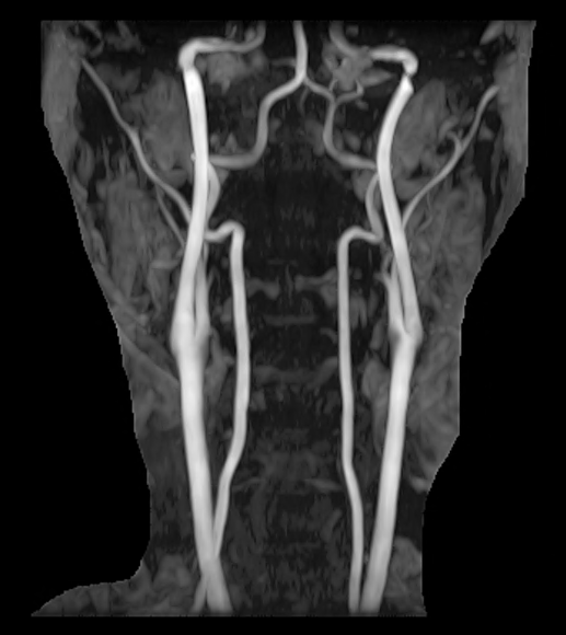 頸動脈MRA検査